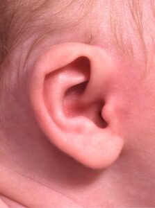 Earwell newborn ear correction baby congenital deformity before after results expert nonsurgical otoplasty