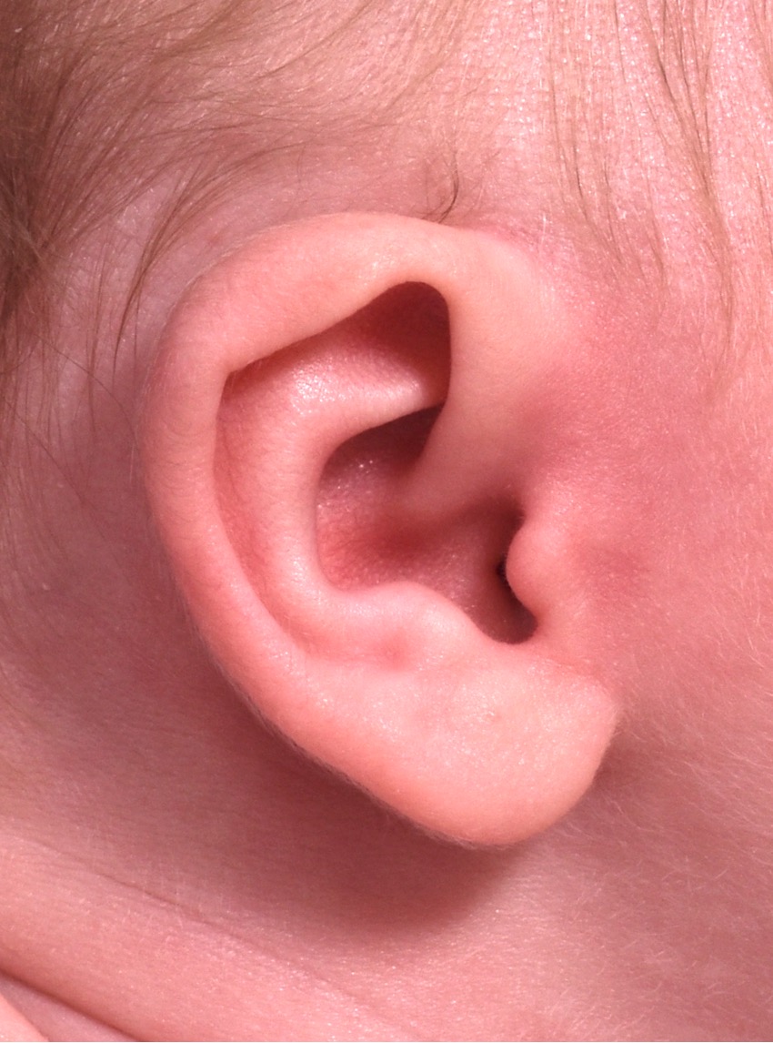 Earwell newborn ear correction baby congenital deformity before after results expert nonsurgical otoplasty