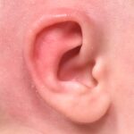 Earwell newborn ear correction baby congenital deformity before after results expert nonsurgical otoplasty