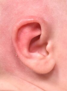 Earwell newborn ear correction baby congenital deformity before after results expert nonsurgical otoplasty