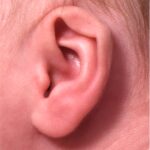 Earwell newborn ear correction baby congenital deformity before after results expert nonsurgical otoplasty