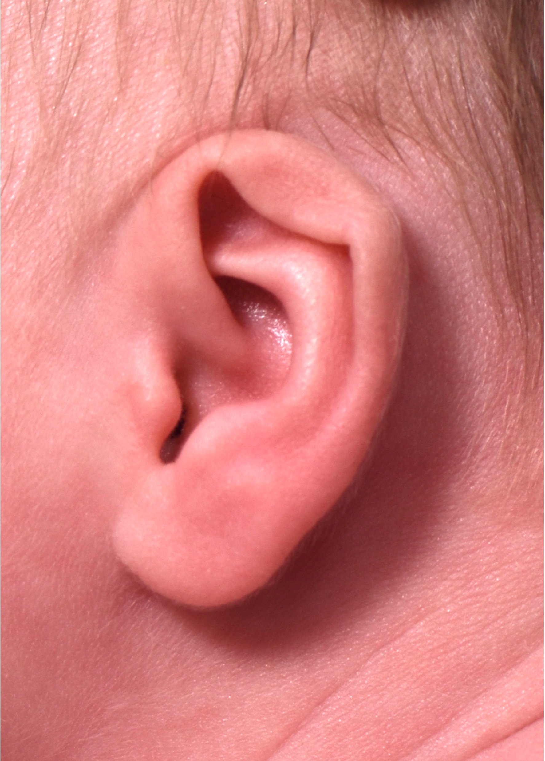 Earwell newborn ear correction baby congenital deformity before after results expert nonsurgical otoplasty