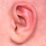 Earwell newborn ear correction baby congenital deformity before after results expert nonsurgical otoplasty