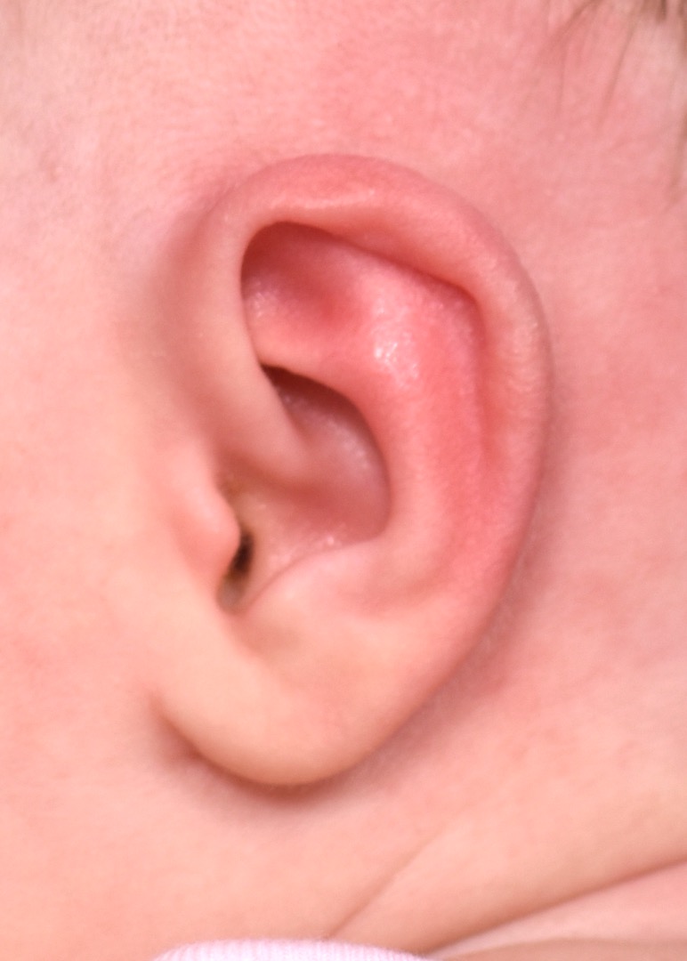 Earwell newborn ear correction baby congenital deformity before after results expert nonsurgical otoplasty