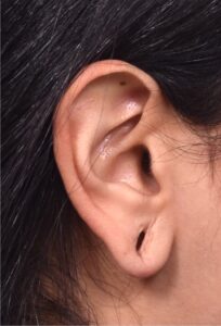 Earlobe repair gauge blowout stretched torn piercing collagen best expert near me