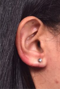 Earlobe repair gauge blowout stretched torn piercing collagen best expert near me