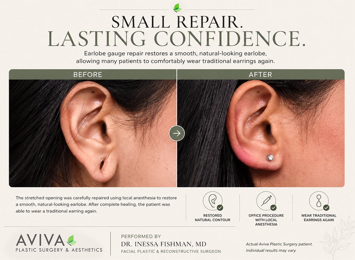 Earlobe gauge repair before and after showing restoration of a stretched earlobe by Dr. Inessa Fishman