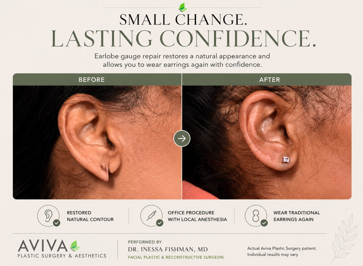 Before and after earlobe repair restoring a torn piercing by Dr. Inessa Fishman
