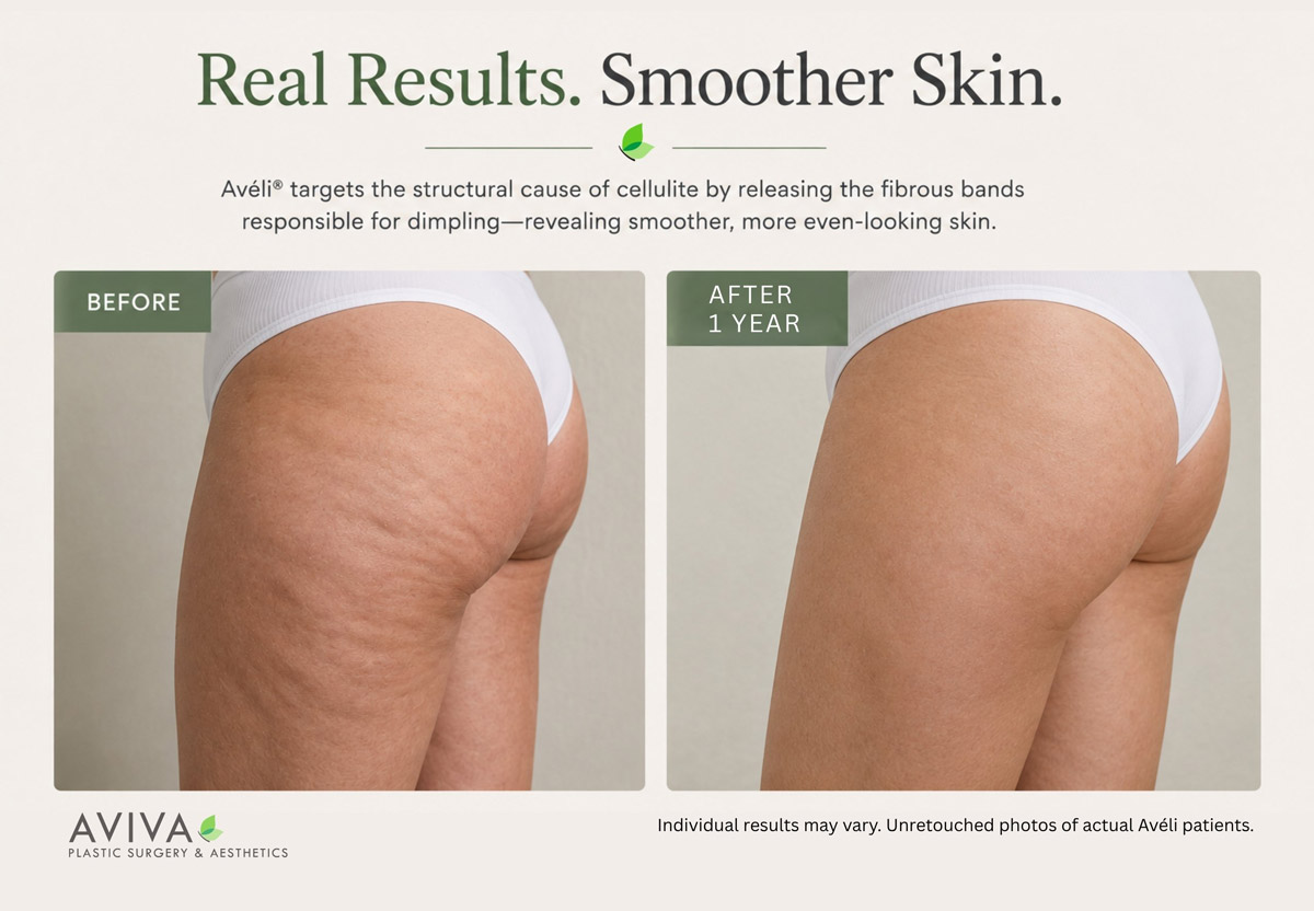 Before and after comparison showing reduced cellulite dimpling on the upper thigh and buttock area