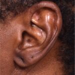 Earlobe repair stretches torn split gauged best near me Atlanta collagen otoplasty ear