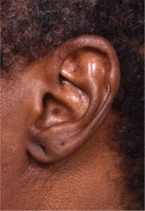 Earlobe repair stretches torn split gauged best near me Atlanta collagen otoplasty ear