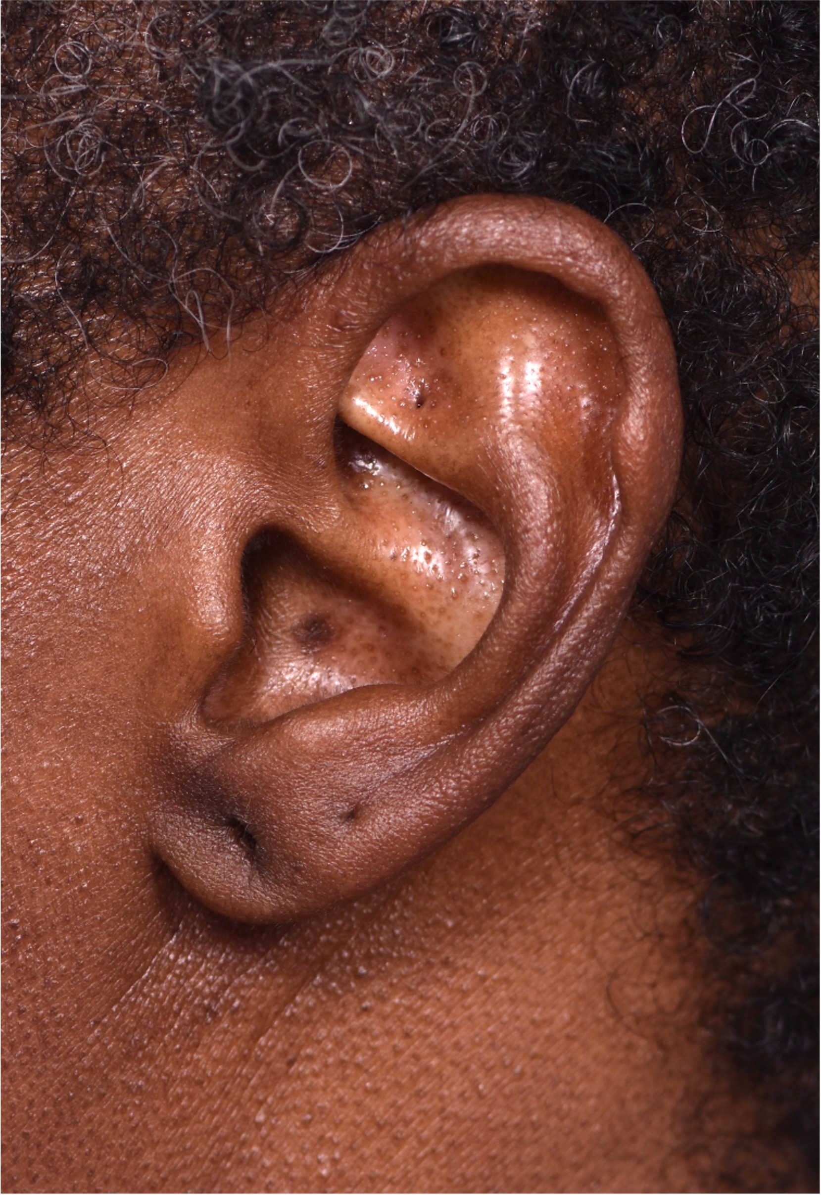 Earlobe repair stretches torn split gauged best near me Atlanta collagen otoplasty ear