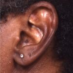Earlobe repair stretches torn split gauged best near me Atlanta collagen otoplasty ear
