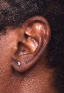 Earlobe repair stretches torn split gauged best near me Atlanta collagen otoplasty ear
