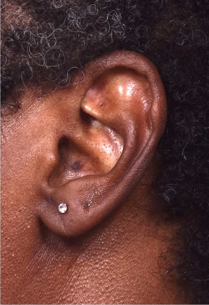 Earlobe repair stretches torn split gauged best near me Atlanta collagen otoplasty ear