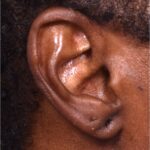 Earlobe repair stretches torn split gauged best near me Atlanta collagen otoplasty ear