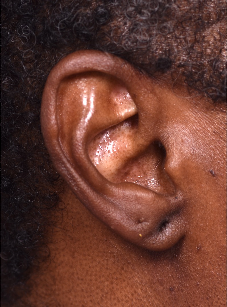 Earlobe repair stretches torn split gauged best near me Atlanta collagen otoplasty ear