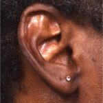 Earlobe repair stretches torn split gauged best near me Atlanta collagen otoplasty ear