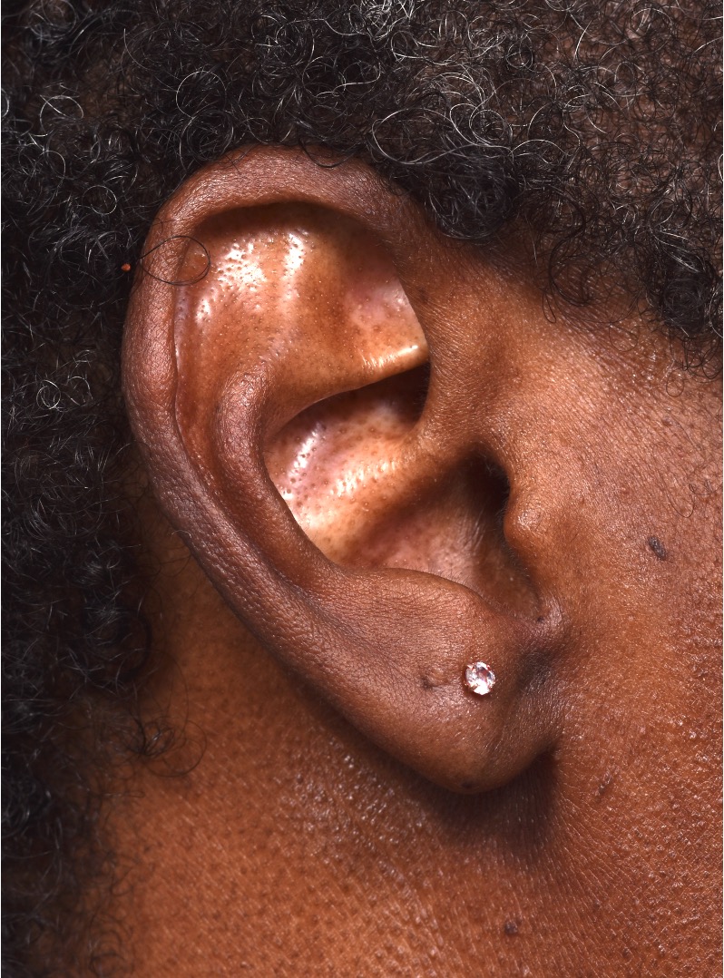 Earlobe repair stretches torn split gauged best near me Atlanta collagen otoplasty ear
