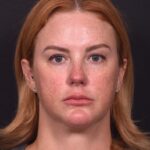 Lip lift surgery before and after best expert near me collagen Atlanta facial balancing corner lip lift