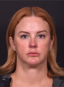 Lip lift surgery before and after best expert near me collagen Atlanta facial balancing corner lip lift