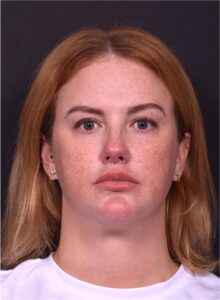 Lip lift surgery corner before and after best expert near me collagen Atlanta facial balancing corner lip lift