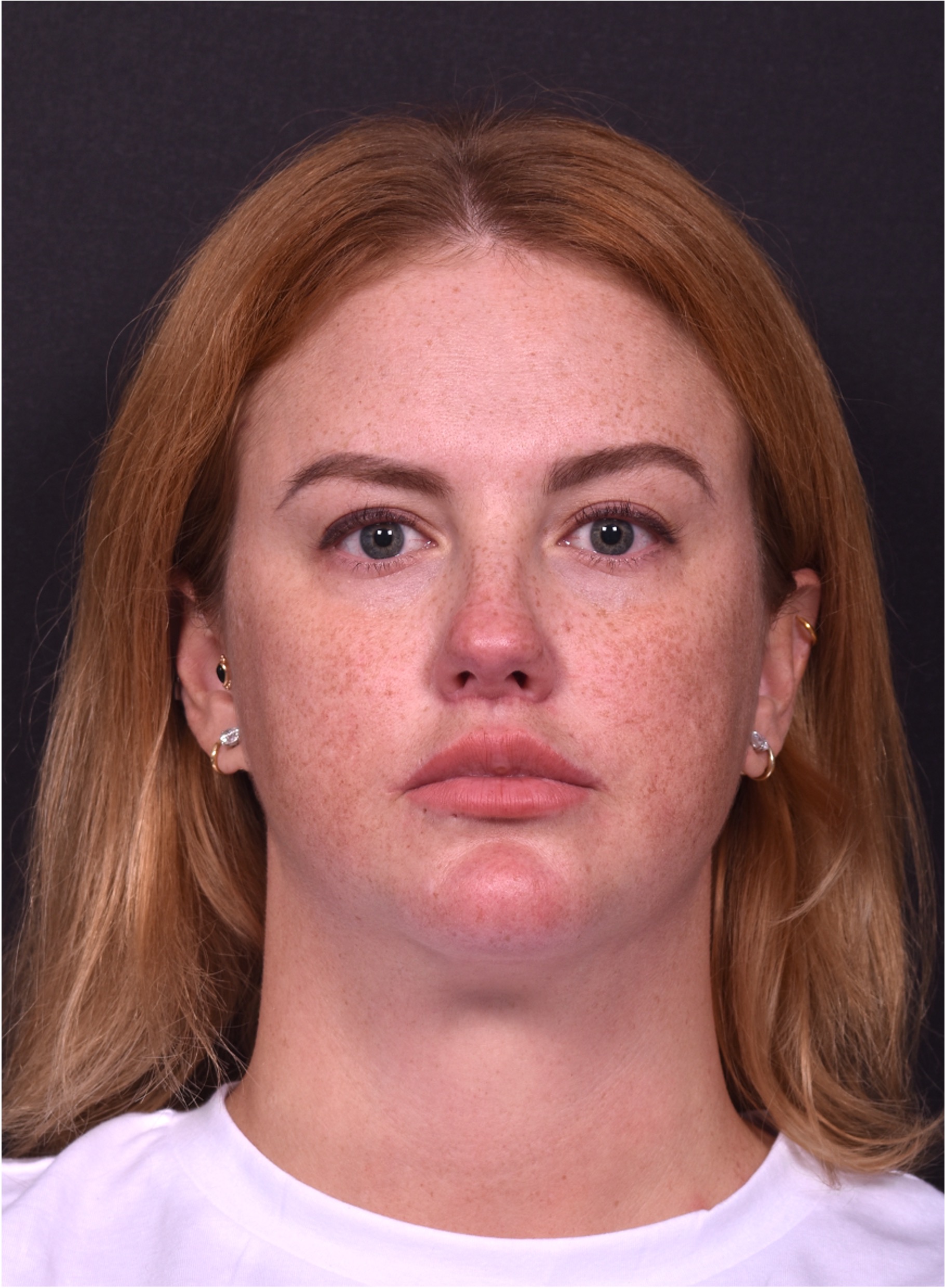 Lip lift surgery corner before and after best expert near me collagen Atlanta facial balancing corner lip lift
