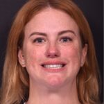 Lip lift surgery corner before and after best expert near me collagen Atlanta facial balancing corner lip lift