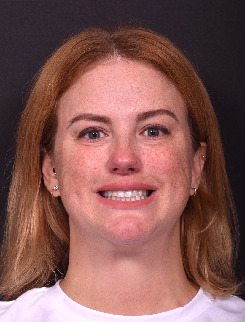 Lip lift surgery corner before and after best expert near me collagen Atlanta facial balancing corner lip lift
