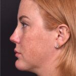 Lip lift surgery corner before and after best expert near me collagen Atlanta facial balancing corner lip lift