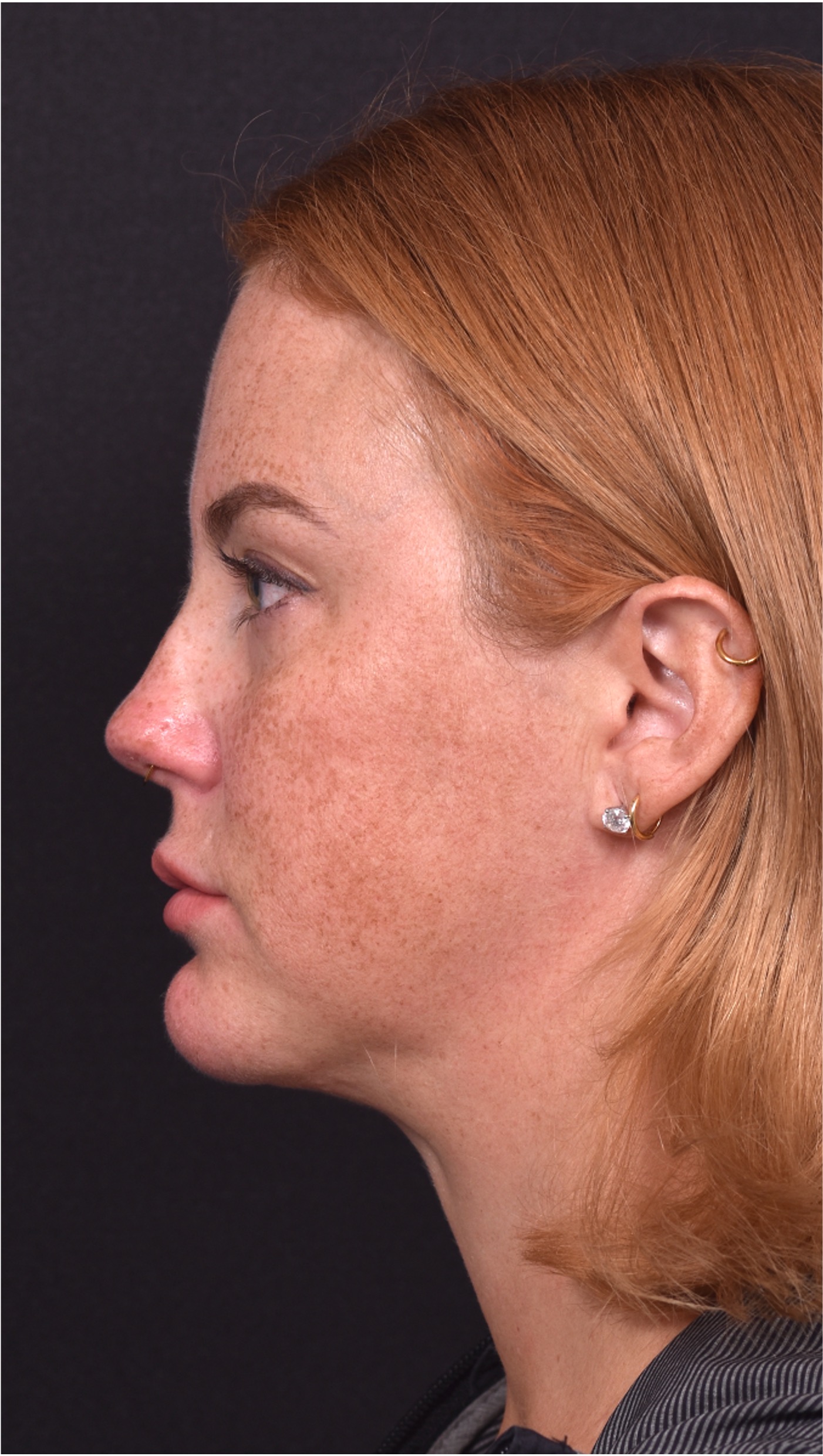 Lip lift surgery corner before and after best expert near me collagen Atlanta facial balancing corner lip lift