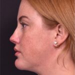 Lip lift surgery corner before and after best expert near me collagen Atlanta facial balancing corner lip lift