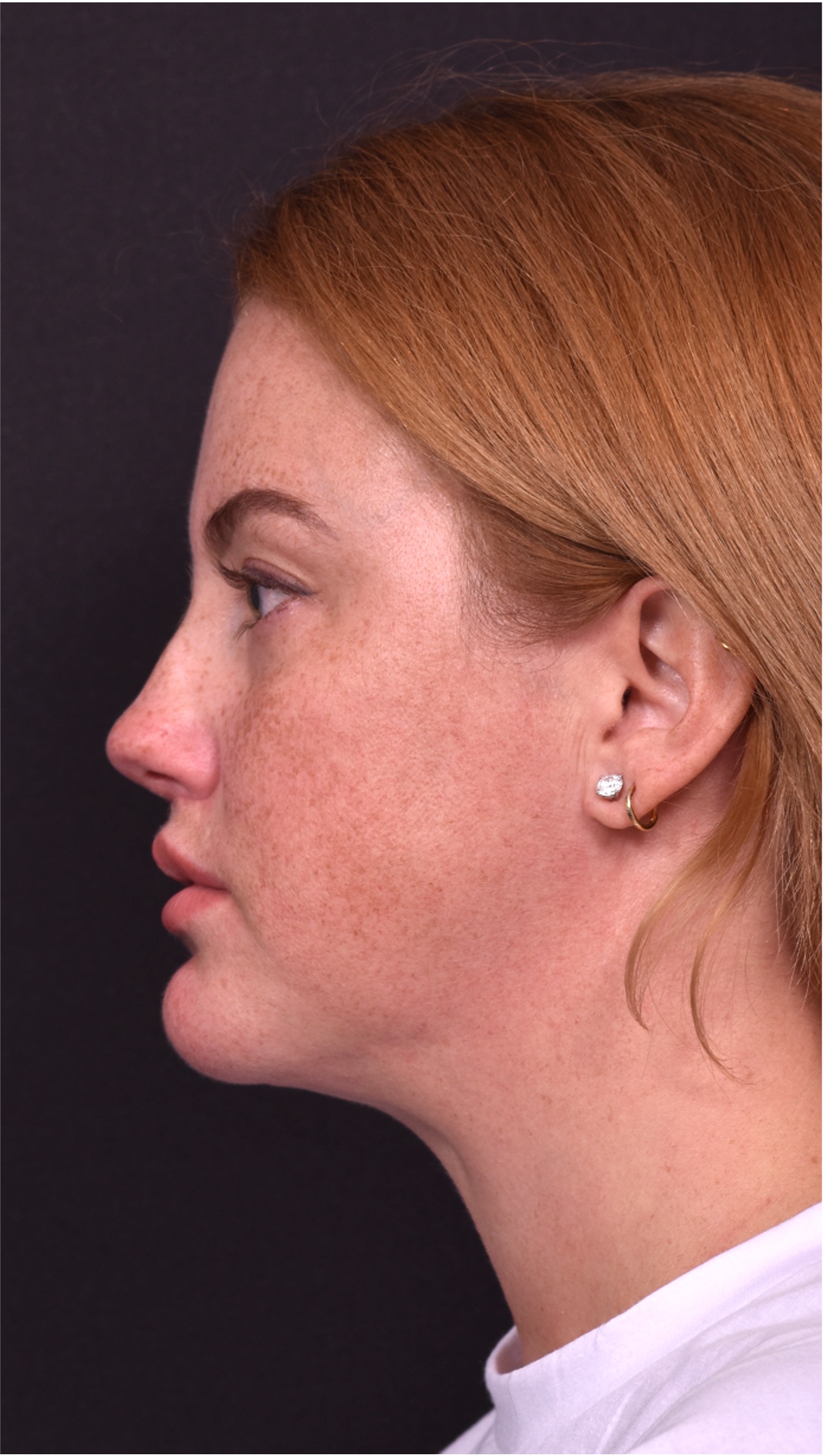 Lip lift surgery corner before and after best expert near me collagen Atlanta facial balancing corner lip lift