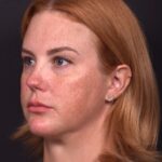 Lip lift surgery corner before and after best expert near me collagen Atlanta facial balancing corner lip lift