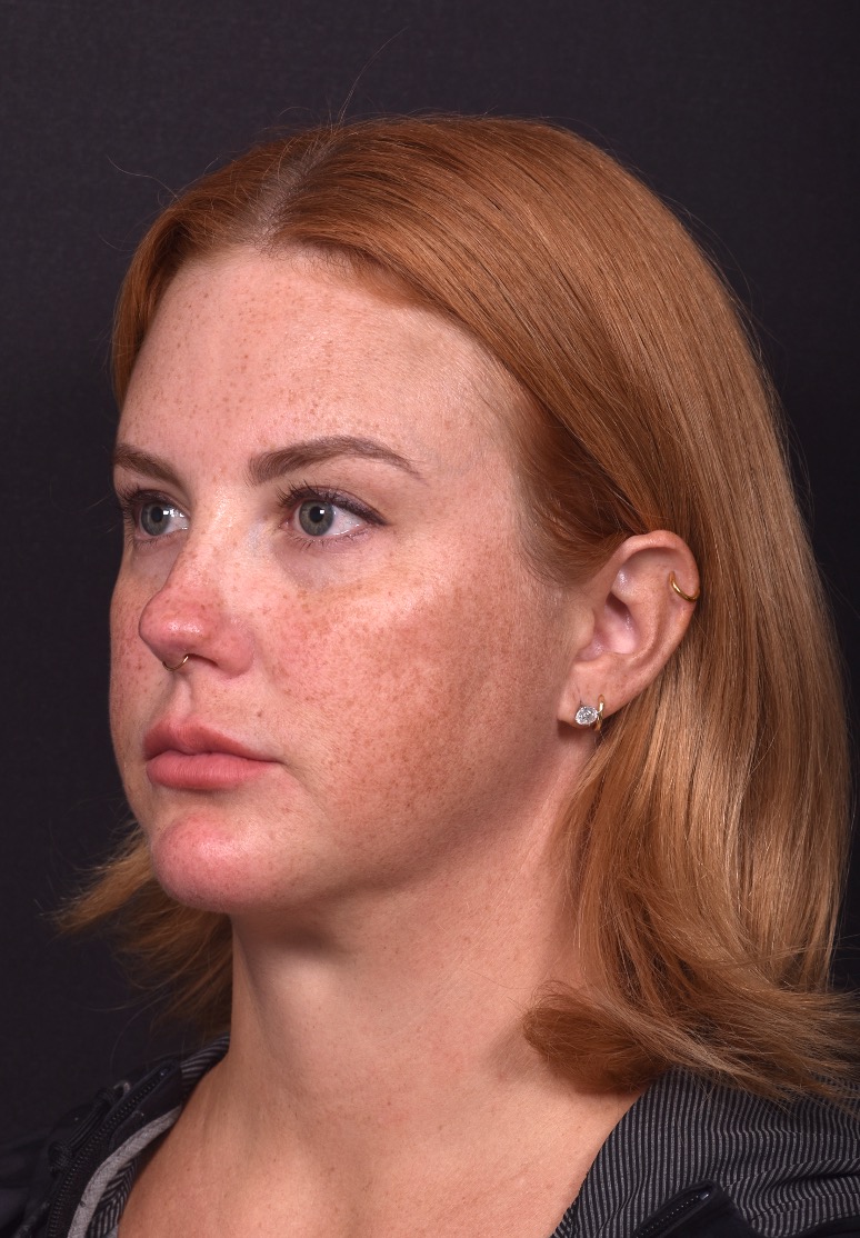 Lip lift surgery corner before and after best expert near me collagen Atlanta facial balancing corner lip lift