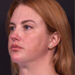 Lip lift surgery corner before and after best expert near me collagen Atlanta facial balancing corner lip lift