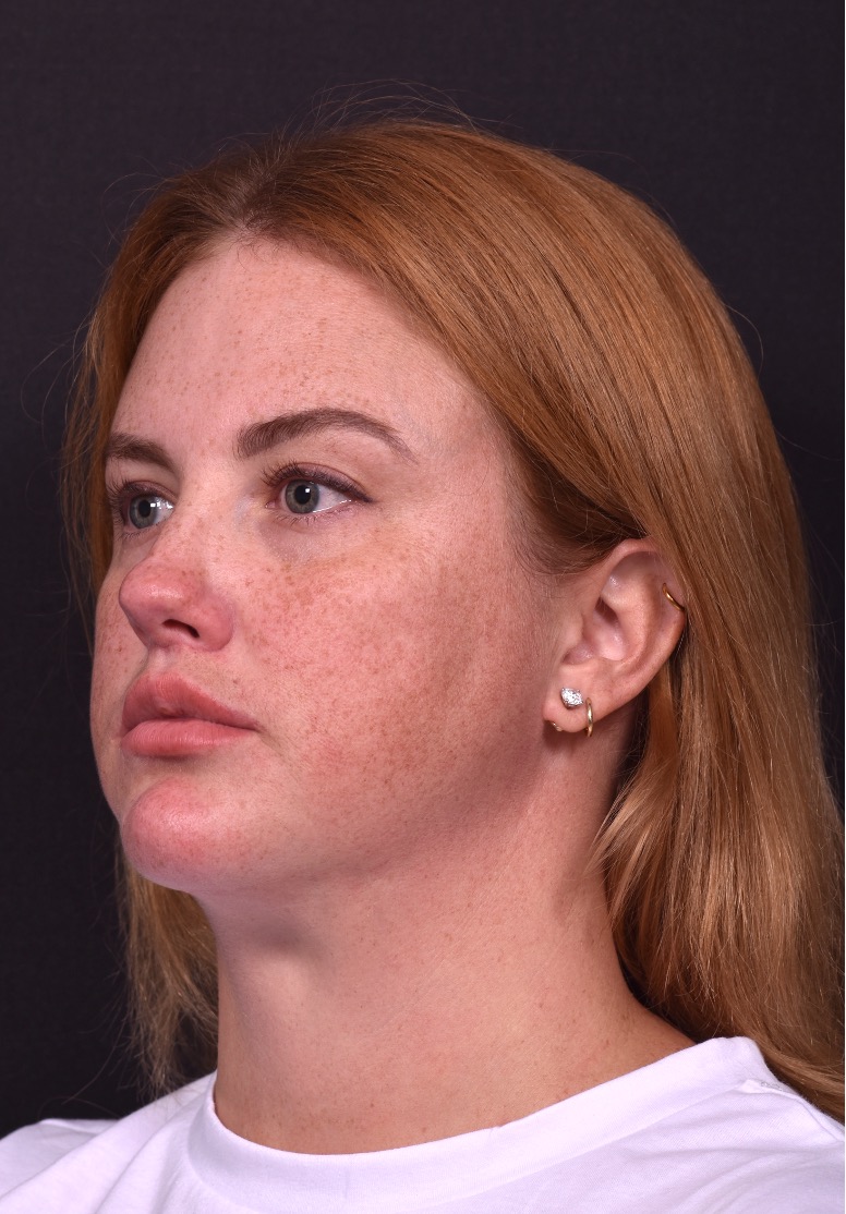 Lip lift surgery corner before and after best expert near me collagen Atlanta facial balancing corner lip lift