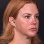 Lip lift surgery corner before and after best expert near me collagen Atlanta facial balancing corner lip lift