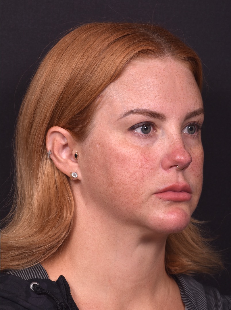 Lip lift surgery corner before and after best expert near me collagen Atlanta facial balancing corner lip lift