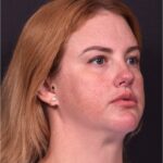 Lip lift surgery corner before and after best expert near me collagen Atlanta facial balancing corner lip lift