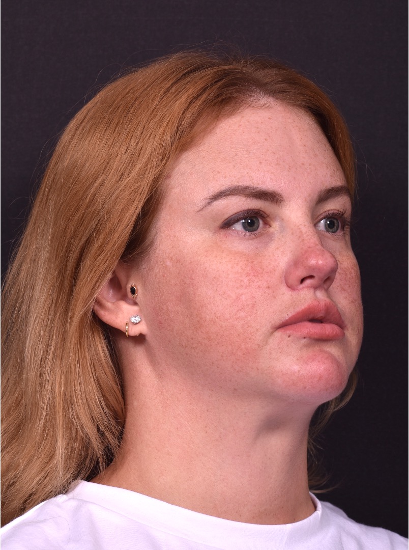 Lip lift surgery corner before and after best expert near me collagen Atlanta facial balancing corner lip lift