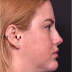 Lip lift surgery corner before and after best expert near me collagen Atlanta facial balancing corner lip lift