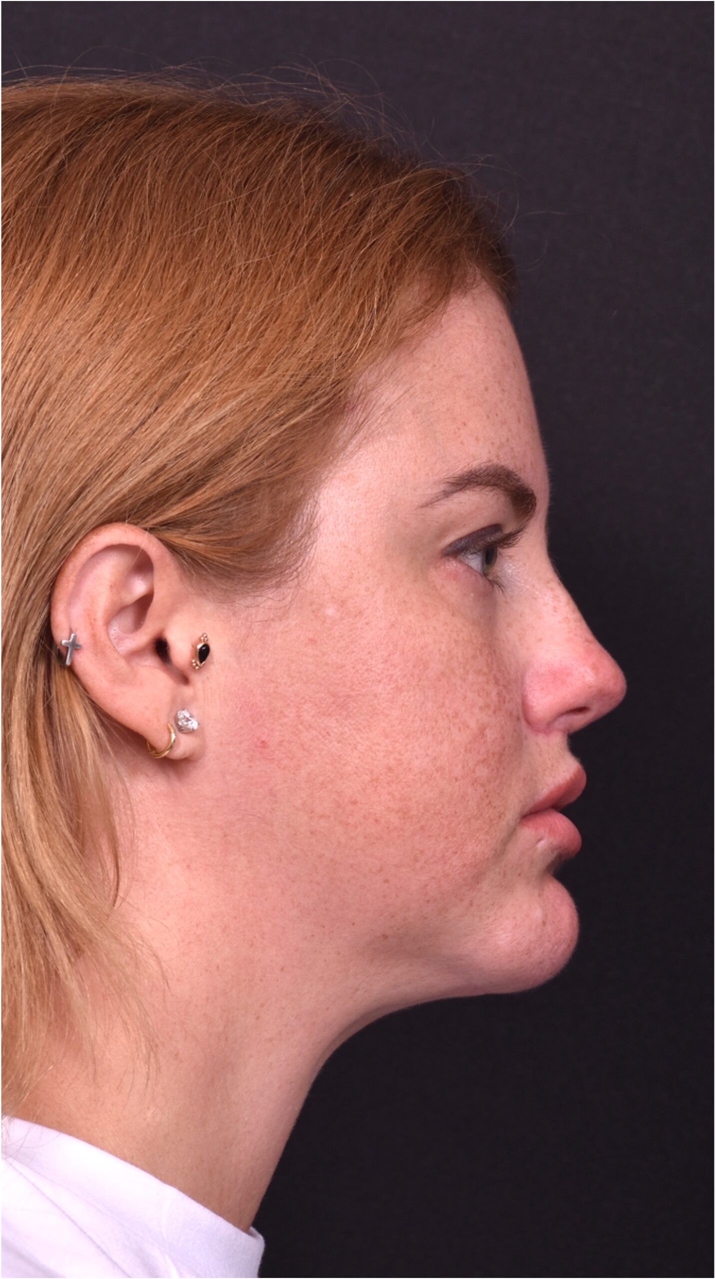 Lip lift surgery corner before and after best expert near me collagen Atlanta facial balancing corner lip lift