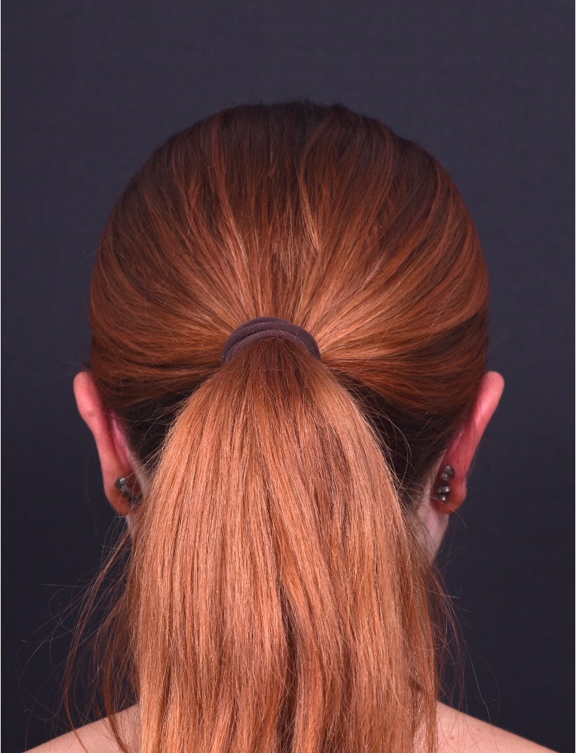 Atlanta otoplasty ear surgery best expert near me collagen art scarless female surgeon