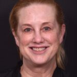 Lip lift best expert near me Atlanta collagen results before and after scarless permanent
