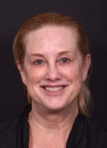 Lip lift best expert near me Atlanta collagen results before and after scarless permanent