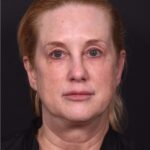 Lip lift best expert near me Atlanta collagen results before and after scarless permanent