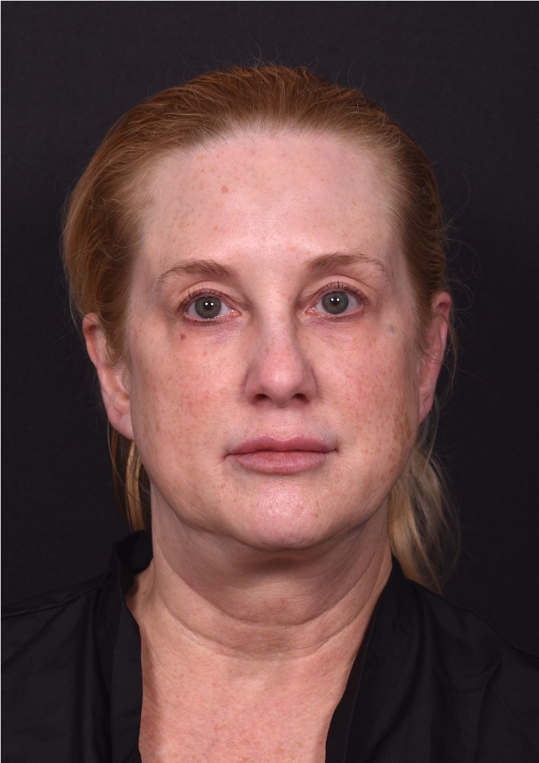 Lip lift best expert near me Atlanta collagen results before and after scarless permanent