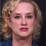 Lip lift best expert near me Atlanta collagen results before and after scarless permanent
