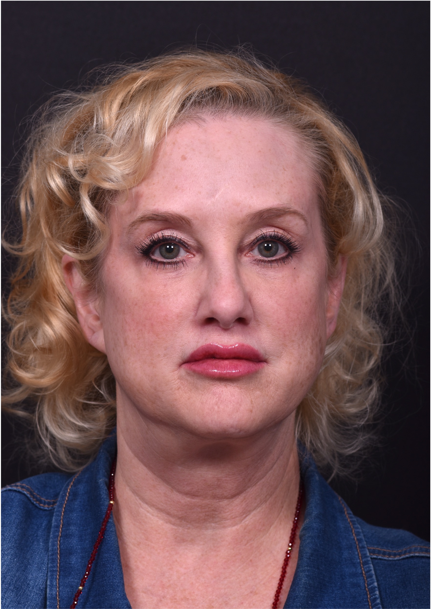 Lip lift best expert near me Atlanta collagen results before and after scarless permanent